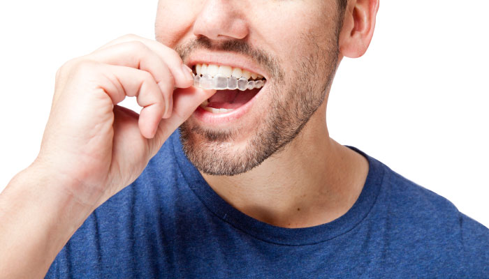 guy putting in invisalign tray