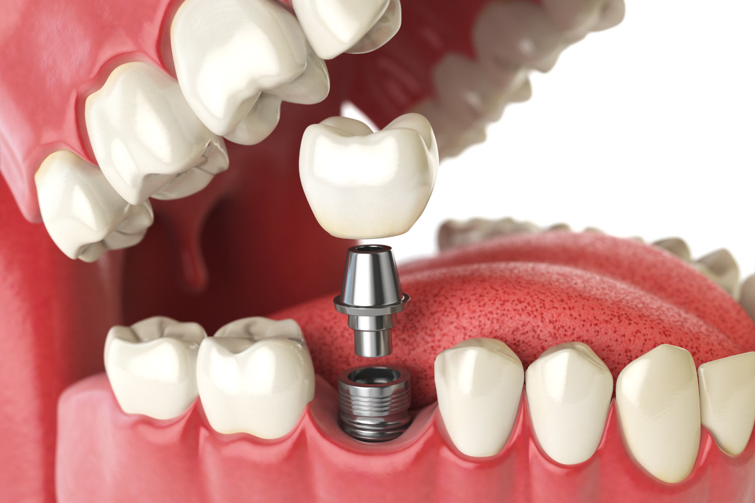 A dental implant replaces a missing permanent tooth