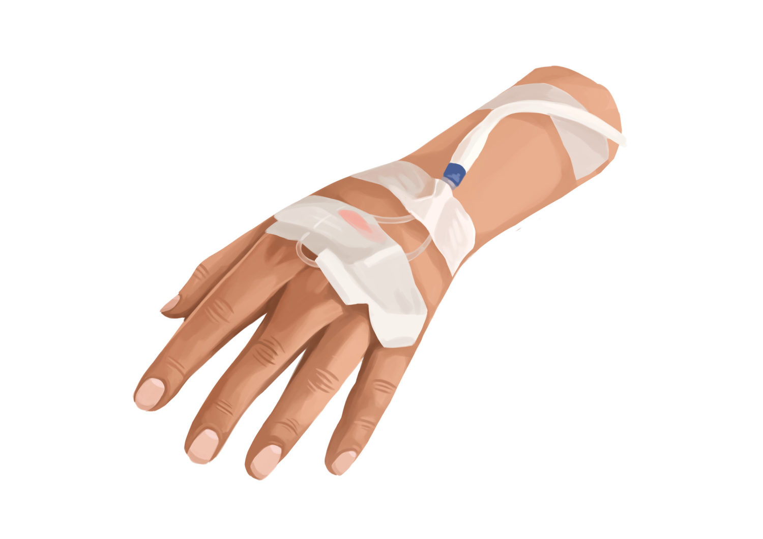 Illustration of a hand with an IV taped onto their wrist administering dental sedation medication